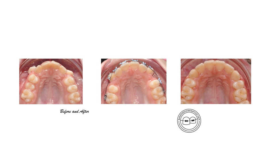 resuls of orthodontic treatment