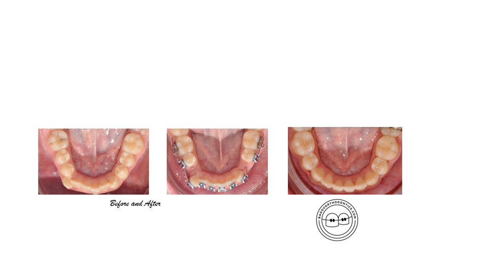 resuls of orthodontic treatment