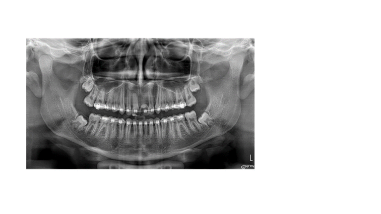 Collaboration with prosthodontics for complex cases: interdisciplinary approaches in orthodontics