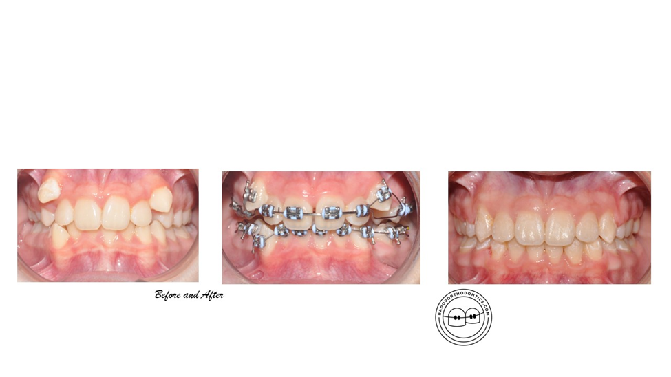 three photos of teeth before orthodontic treament, with braces and the result after the treatment