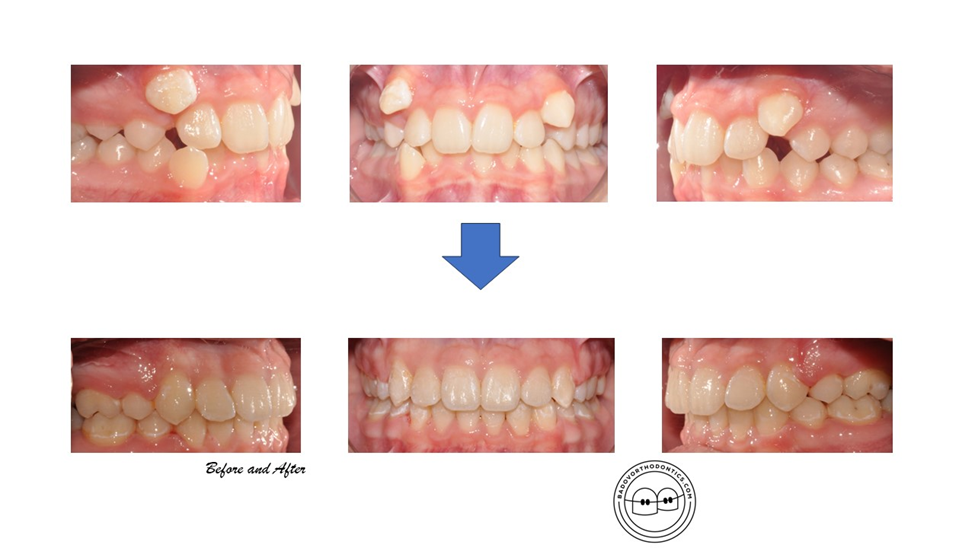 resuls of orthodontic treatment