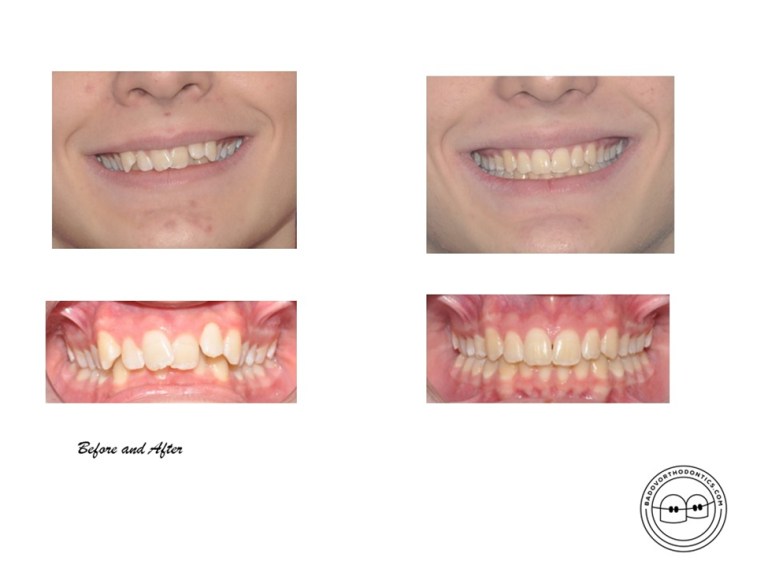 Overbite Teeth: Anatomy, Related Problems, Treatment, Before and After Cases