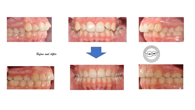 Placing Braces Before and After